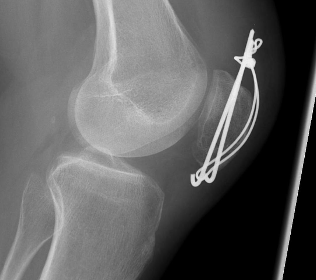 Patella TBW Lateral